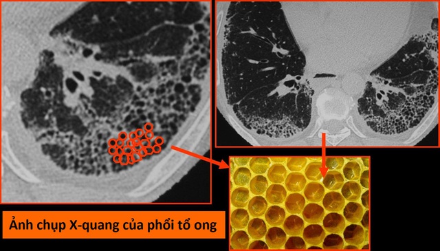 Viêm phổi kẽ